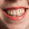 Crown Lengthening Before