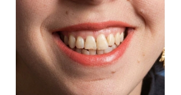 Crown Lengthening Before
