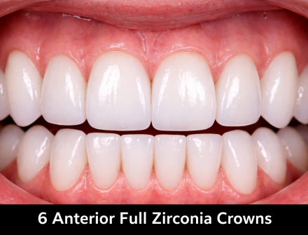 Edentalab - Product - Zirconia