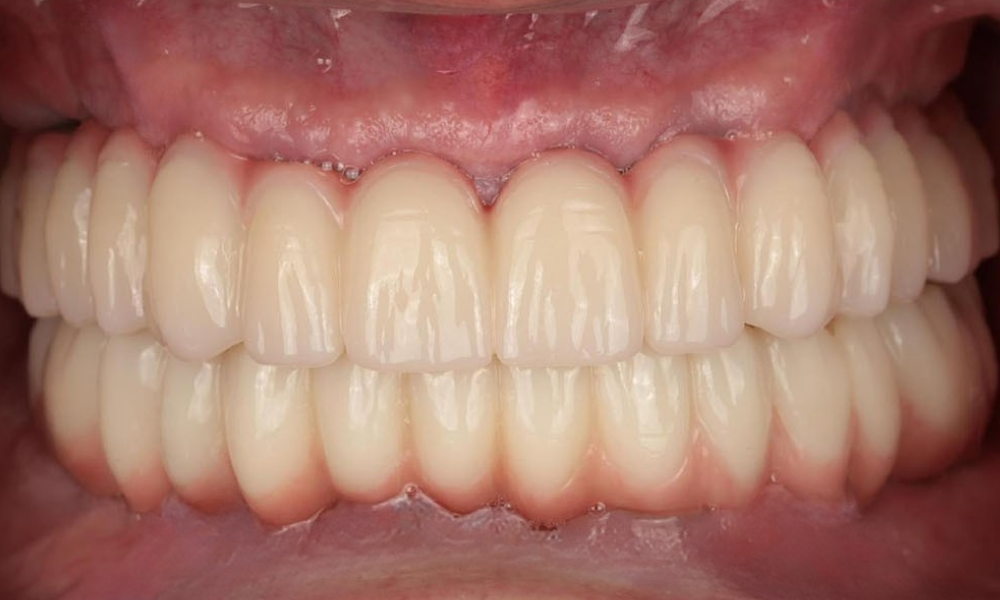 Full ARCH IMPLANT RESTORATION 