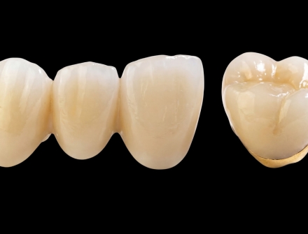 PFM (Porcelain-Fused-to-Metal) - ATTACHMENTS